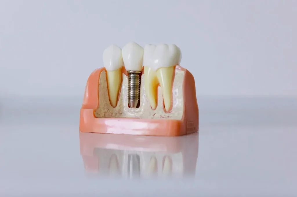 Dental implants